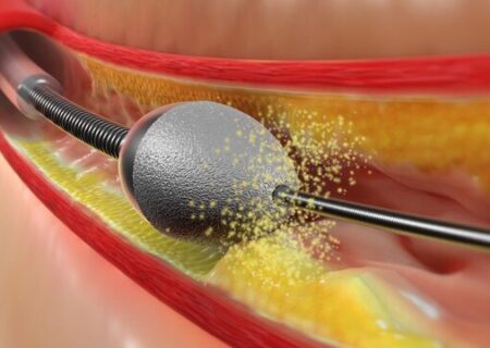 فناوری روتابلاتور عروق قلبی در دسترس بیماران خوزستانی قرار گرفت