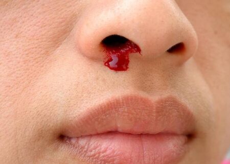 شایع‌ترین علل خونریزی بینی؛ چه زمانی به پزشک مراجعه کنیم