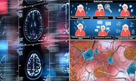 بالاخره معلوم شد چرا زنان بیشتر از مردان آلزایمر میگیرند!