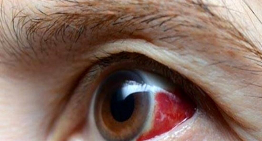 پیشگیری از سکته چشمی: راهکارها و عوامل خطرساز