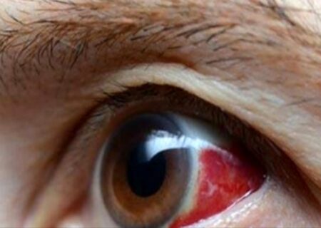 پیشگیری از سکته چشمی: راهکارها و عوامل خطرساز