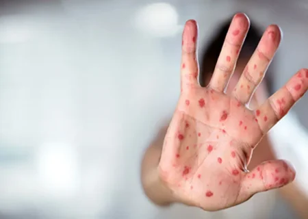 نگرانی از همه‌گیری سرخک