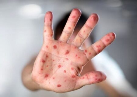 ۳عامل بروز سرخک در ایران/شیوع بیماری تحت کنترل است