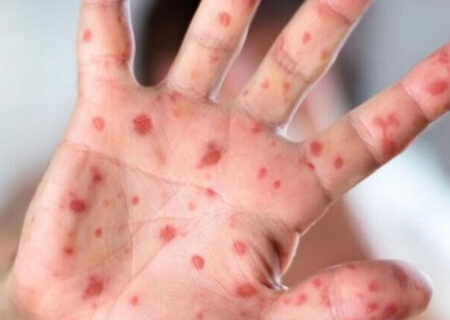 افزایش موارد مشکوک به سرخک در دزفول