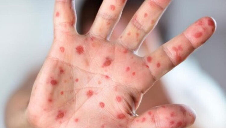 افزایش موارد مشکوک به سرخک در دزفول