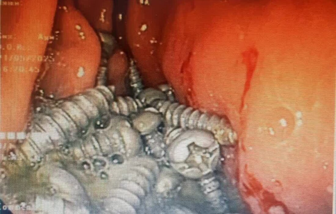 خارج کردن ۴۷ پیچ فلزی از معده یک بیمار در کرج