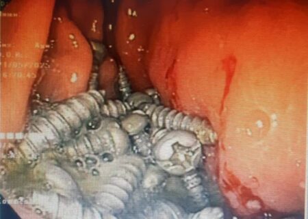 خارج کردن ۴۷ پیچ فلزی از معده یک بیمار در کرج