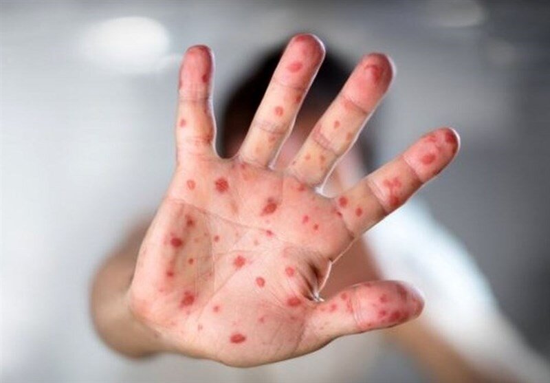 آخرین وضعیت شیوع سرخک در ایران/ بیشتر مبتلایان اتباع خارجی هستند