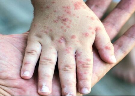 دلایل افزایش ابتلا به سرخک طی روزهای اخیر