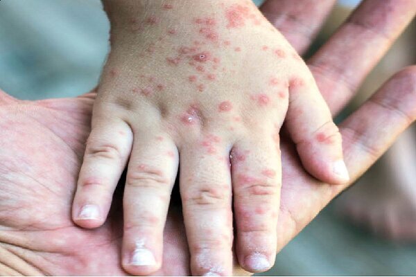 دلایل افزایش ابتلا به سرخک طی روزهای اخیر