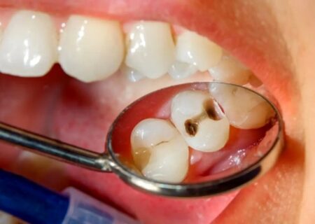 چگونه از 5 اشتباه رایج پوسیدگی دندان جلوگیری کنیم؟
