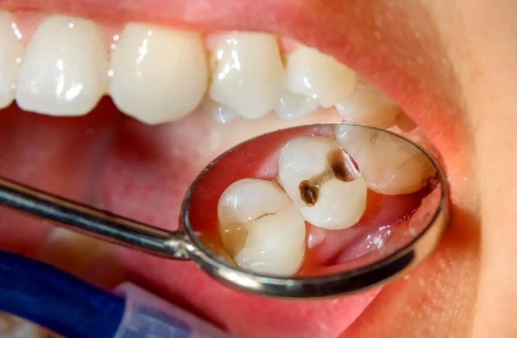 چگونه از 5 اشتباه رایج پوسیدگی دندان جلوگیری کنیم؟