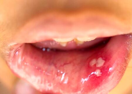 مشاهده HPV دهانی در افراد 13 تا 75 ساله! / فروش واکسن گارداسیل با قیمت نجومی بدون تضمین سلامت / تست های HPV دهانی تا 70 درصد نتیجه منفی کاذب دارد!