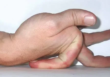 انعطاف‌پذیری بیش از حد انگشتان احتمالا نشانه‌ یک بیماری جدی است