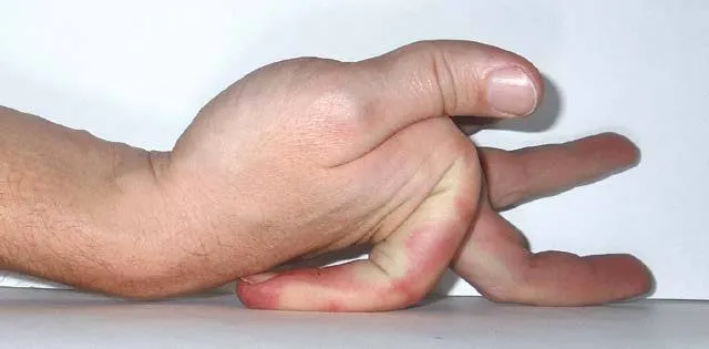 انعطاف‌پذیری بیش از حد انگشتان احتمالا نشانه‌ یک بیماری جدی است