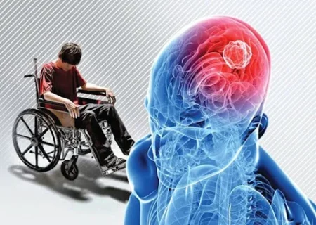 این تغییر در بینایی میتواند نشانه ام اس باشد