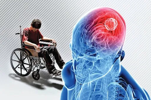 این تغییر در بینایی میتواند نشانه ام اس باشد