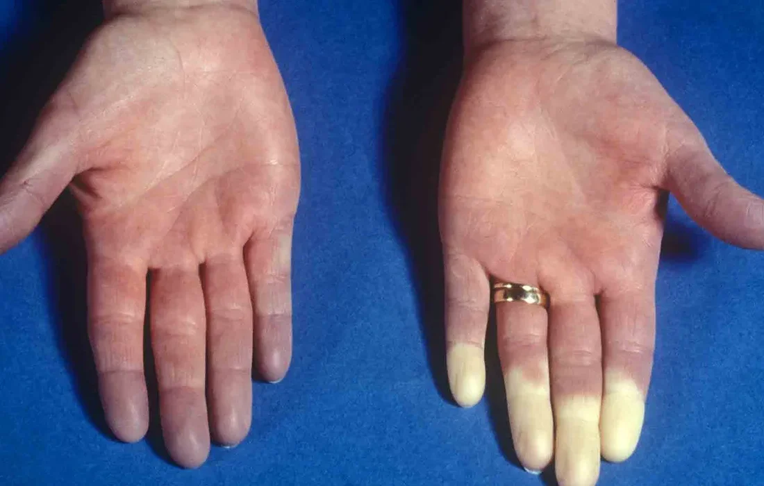 سردی بیش از اندازه بدن را چطور درمان کنیم؟