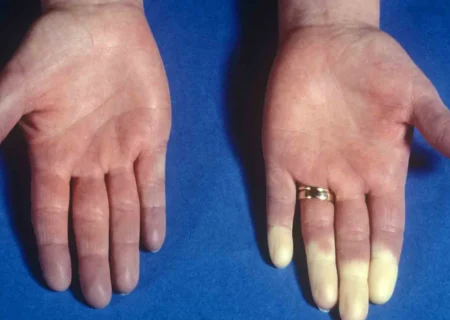 سردی بیش از اندازه بدن را چطور درمان کنیم؟