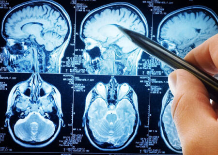 پیشگیری از ۸۰ درصد سکته‌های مغزی با چند توصیه‌ بهداشتی