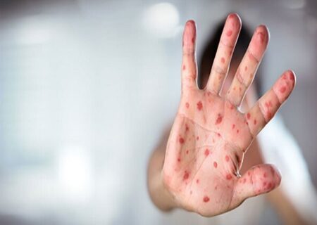 افزایش موارد ابتلا به سرخک در خوزستان در ماه‌های اخیر