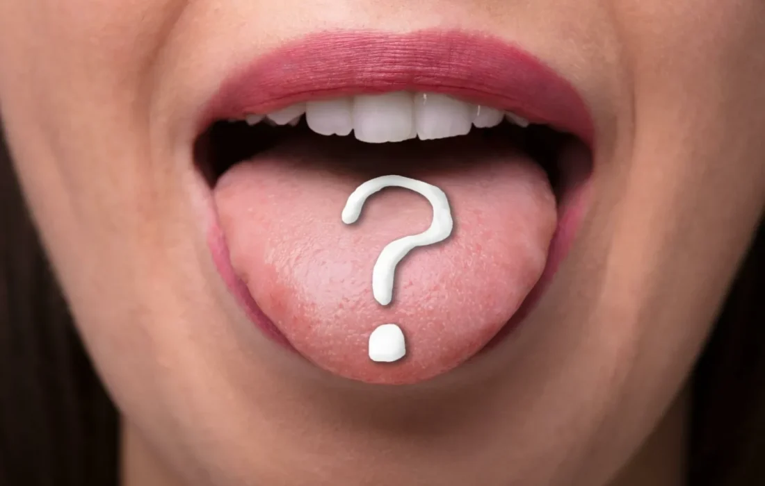 لکه‌های سیاه روی زبان نگران‌کننده است؟ با دلایل اصلی و راه‌های درمان آن آشنا شوید
