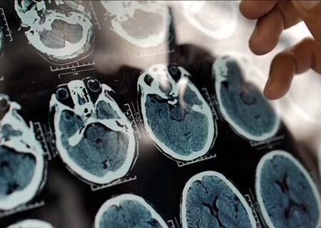 هشدار درباره شروع یک بیماری سخت از ۴۰ سالگی