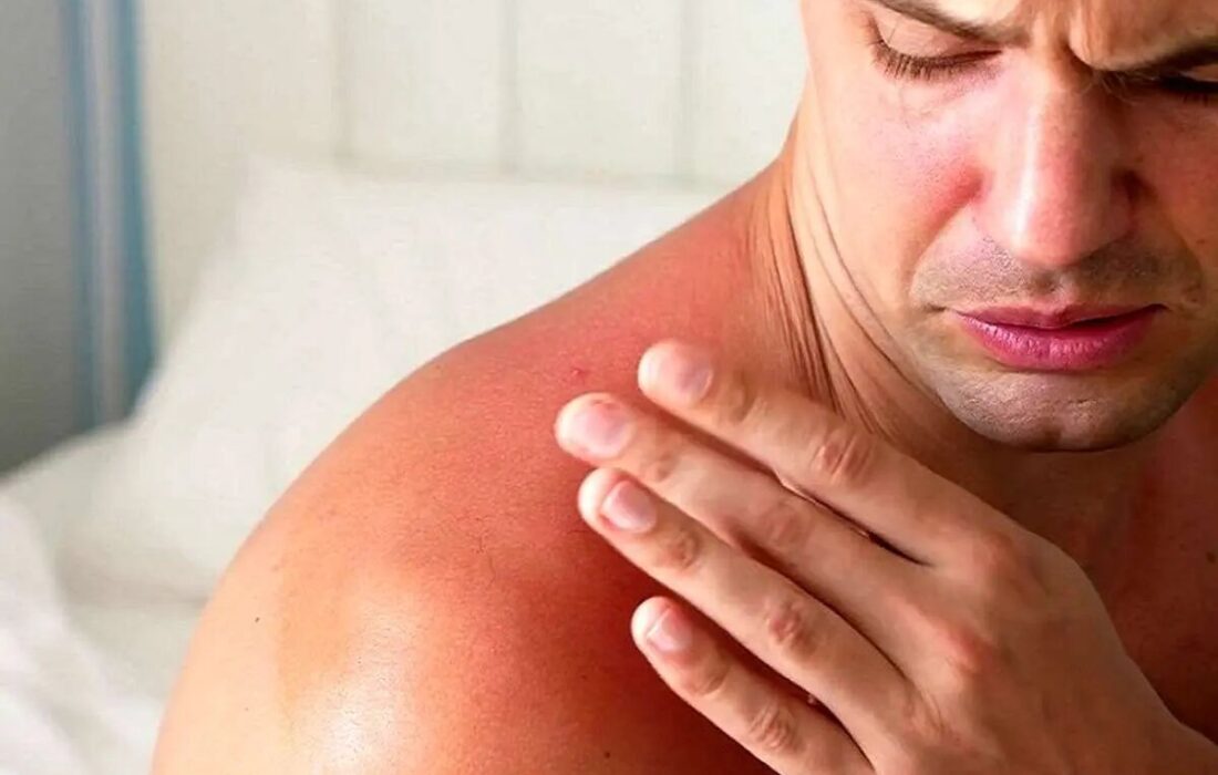 هشدار؛ مراقب سوختگی‌های پنهان آفتاب باشید