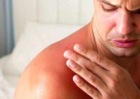 هشدار؛ مراقب سوختگی‌های پنهان آفتاب باشید