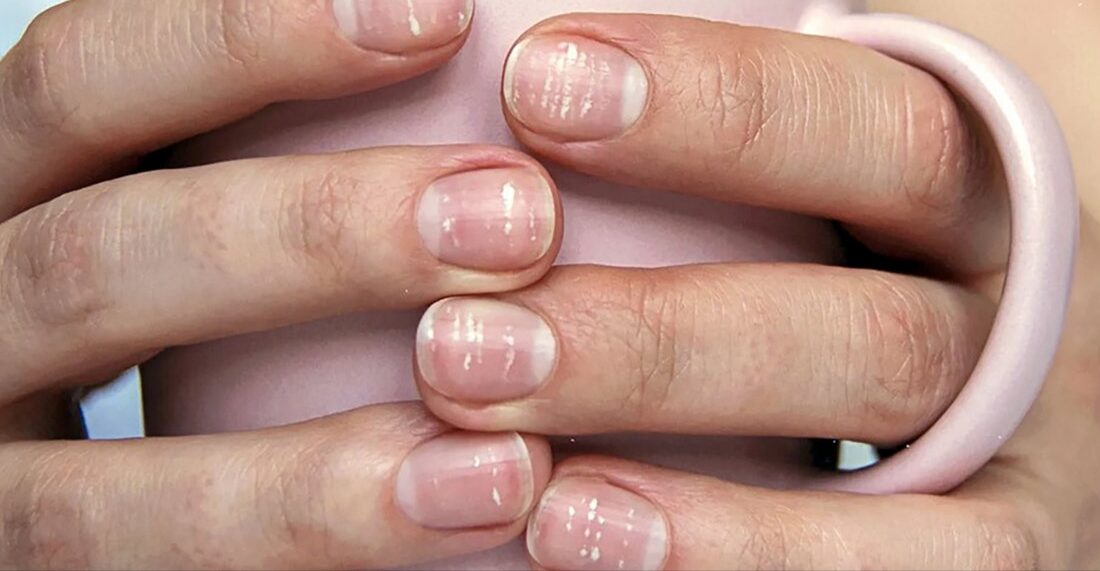 نقاط سفید روی ناخن نشانه کم خونی است؟
