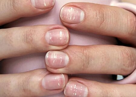 نقاط سفید روی ناخن نشانه کم خونی است؟