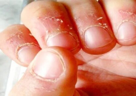 علت پوست‌پوست شدن اطراف ناخن و روش‌های درمان