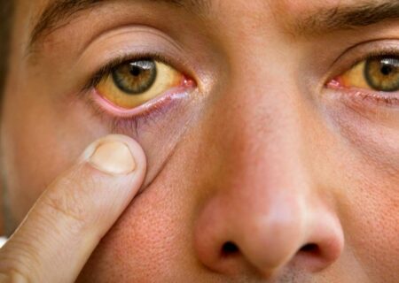 ایران در مسیر حذف هپاتیت بی / افراد معتاد تزریقی و کسانی که سابقه حبس دارند، هنوز در معرض شیوع بالای بیماری هستند