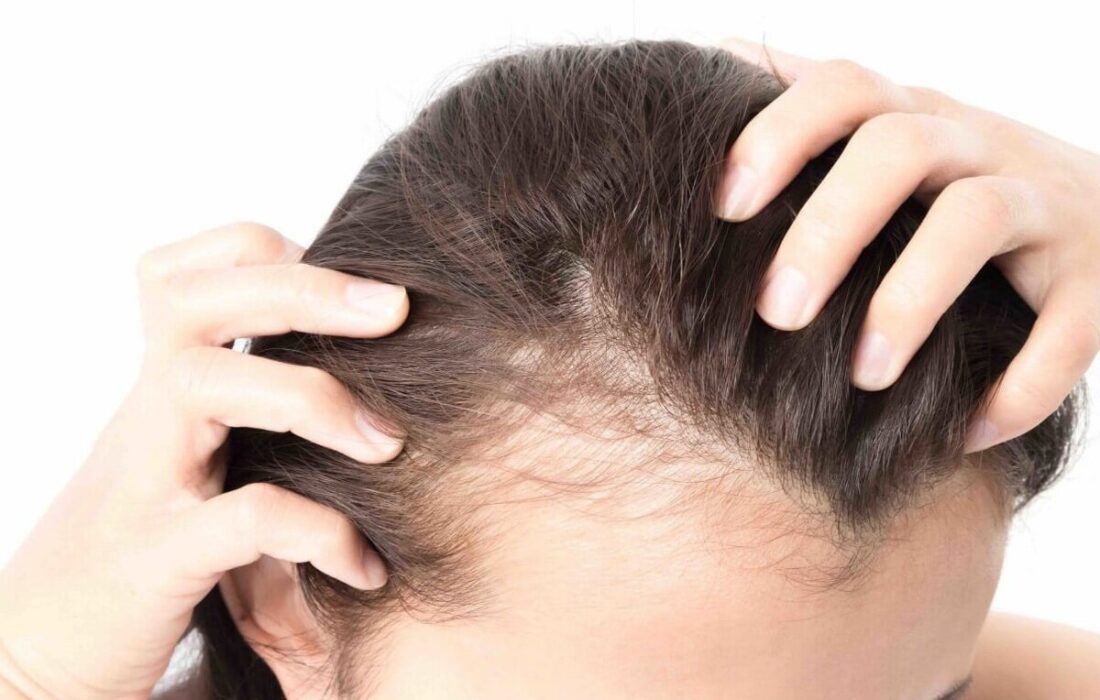 چهار توصیه مهم برای کسانی که ریزش مو دارند