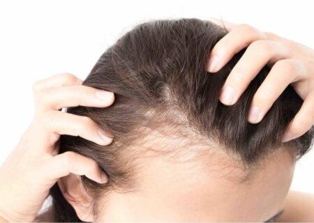 چهار توصیه مهم برای کسانی که ریزش مو دارند