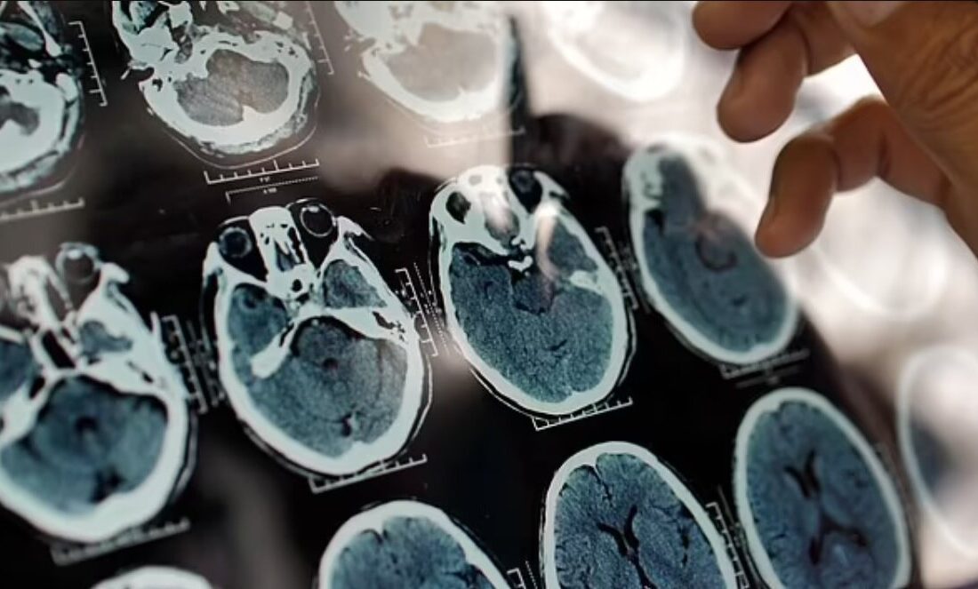 با مصرف این لبنیات از آلزایمر نجات پیدا کنید