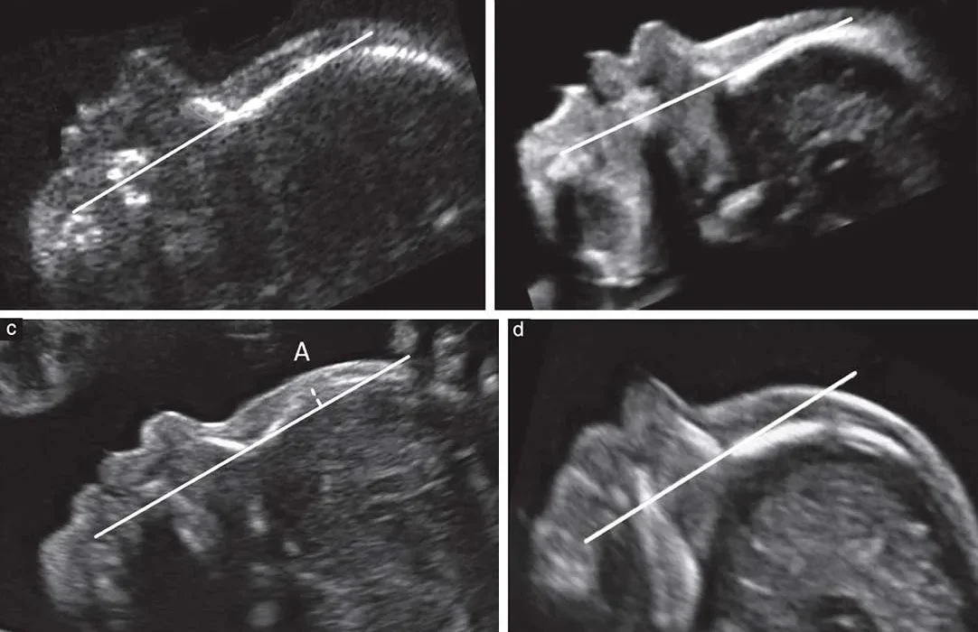 غربالگری در دوران بارداری ممنوع نیست و همچنان انجام میشود