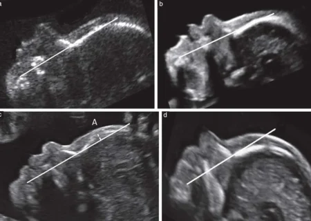 غربالگری در دوران بارداری ممنوع نیست و همچنان انجام می‌شود