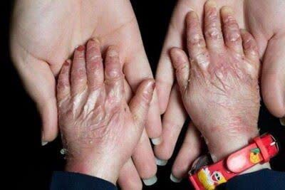 پانسمان حیاتی بیماران پروانه‌ای در فهرست تحریم‌هاست / هیچ کودک پروانه‌ای نباید از تحصیل بازبماند