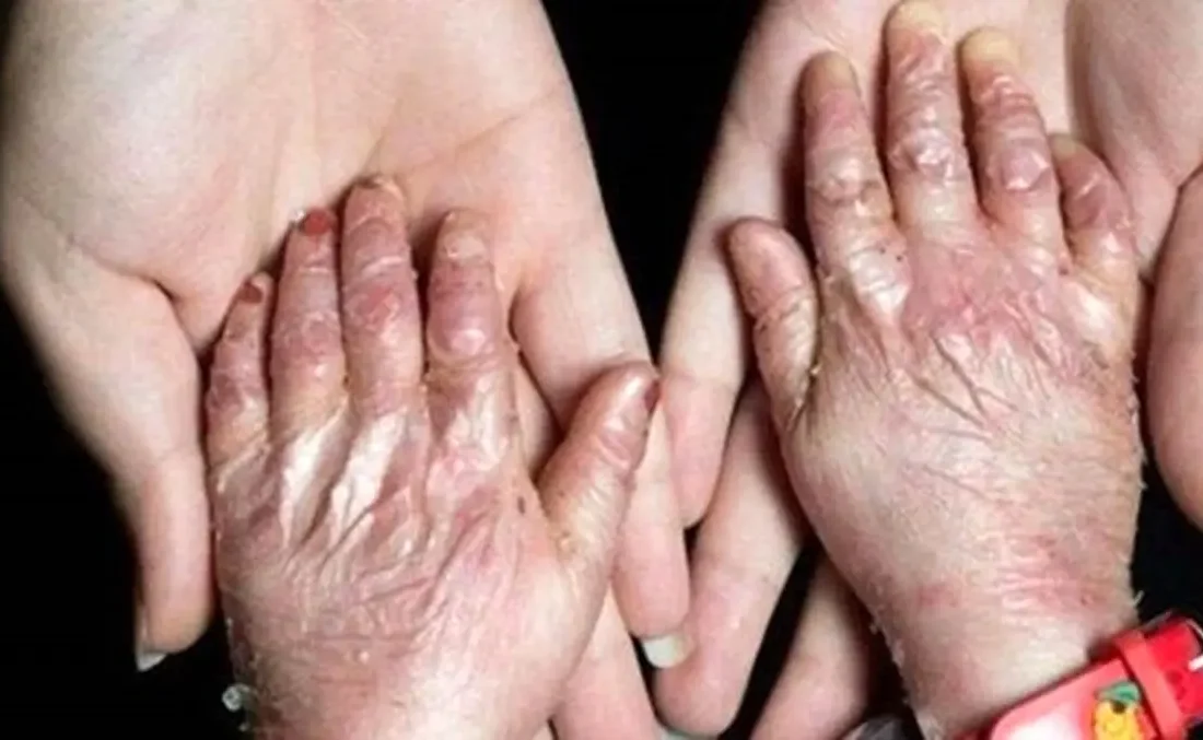 بیماری پروانهای بیشتر در خانواده های دارای ازدواج فامیلی بروز میکند