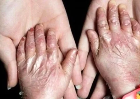 بیماری پروانه‌ای بیشتر در خانواده‌ های دارای ازدواج فامیلی بروز می‌کند