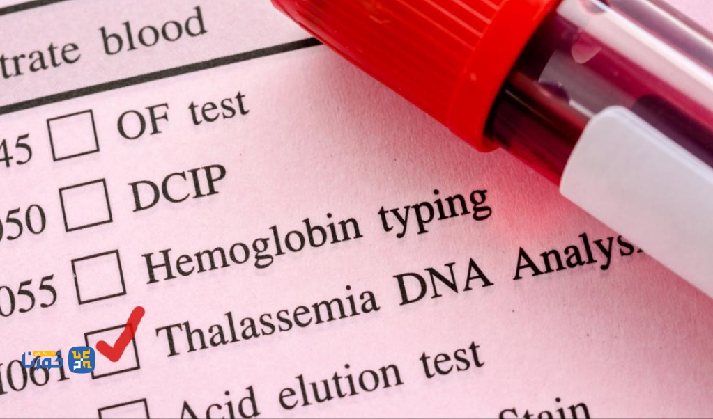 شناسایی بیش از ۱۸۰۰ زوج ناقل بیماری تالاسمی در خوزستان