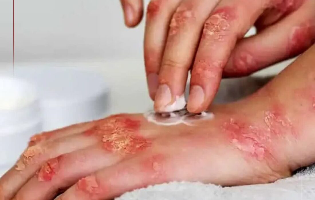 ابتلای یک درصد جمعیت کشور به سلیاک/ شیوع بالاتر در مناطق غربی کشور؛ علائم بیماری چیست؟