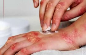 ابتلای یک درصد جمعیت کشور به سلیاک/ شیوع بالاتر در مناطق غربی کشور؛ علائم بیماری چیست؟