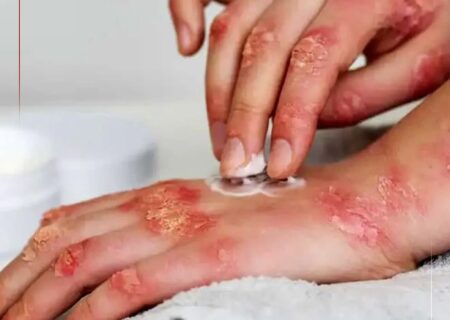 ابتلای یک درصد جمعیت کشور به سلیاک/ شیوع بالاتر در مناطق غربی کشور؛ علائم بیماری چیست؟